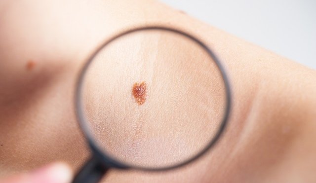 MELANOMA